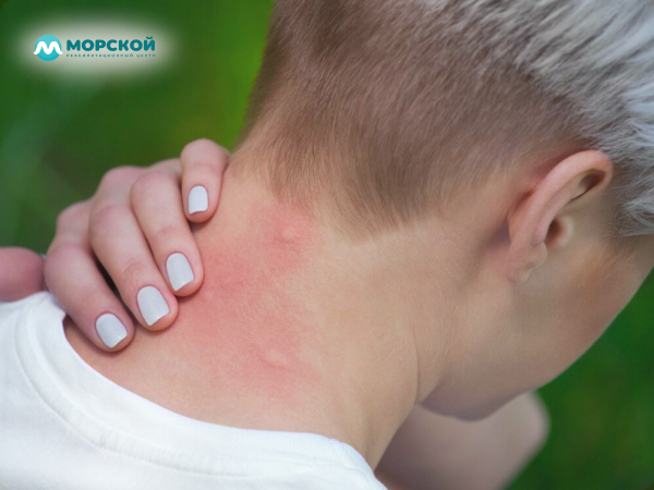 Аллергия на шее